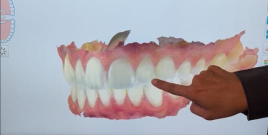 3D model of the scanned area within the mouth showing the tooth that needs a crown as well as the teeth on either side.